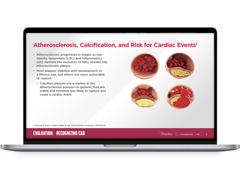 Medical presentation slide on a laptop